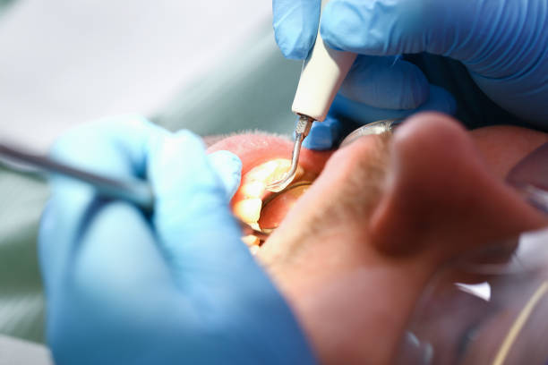 Best Emergency Wisdom Teeth Removal in Rockwell, AR